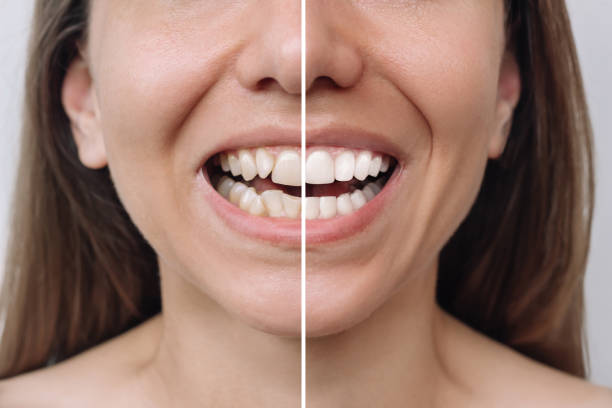 Dental veneers